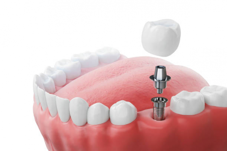 Clinica de Implante de Protese Dentaria Fixa Socorro - Implantes de Dentes