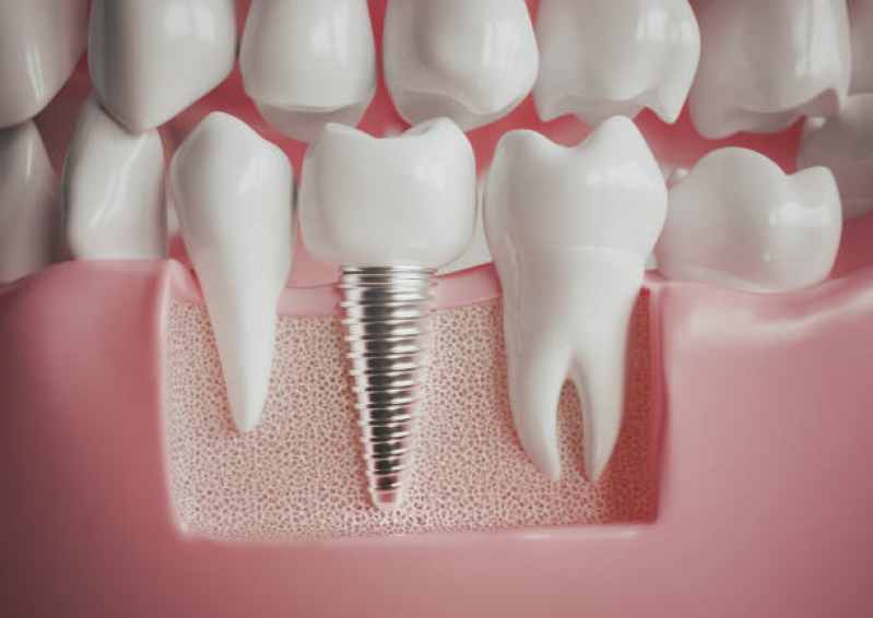 Clinica de Implante de Todos Os Dentes Alameda Joaquim Eugênio - Implante no Dente da Frente