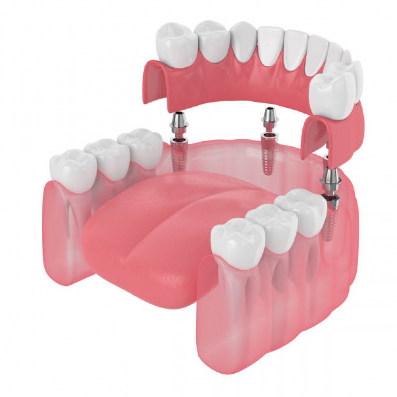 Clinica de Implante Dentário Completo Augusta - Implante Dentário de Porcelana
