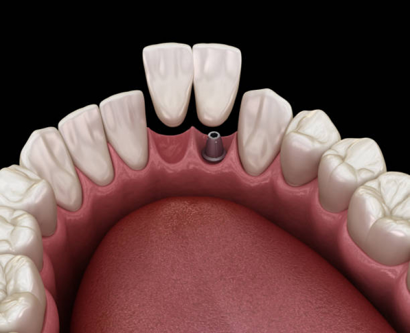 Clinica de Implante Dentário de um Dente Campo Belo - Implante Dentario Total
