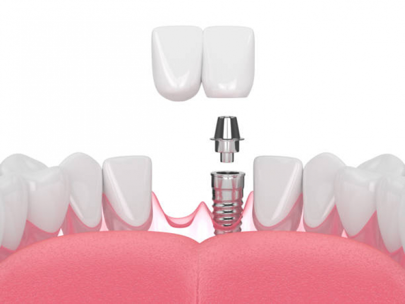Clinica de Implante Dentario Dente da Frente Vila Clementino - Implante Dentário de Porcelana