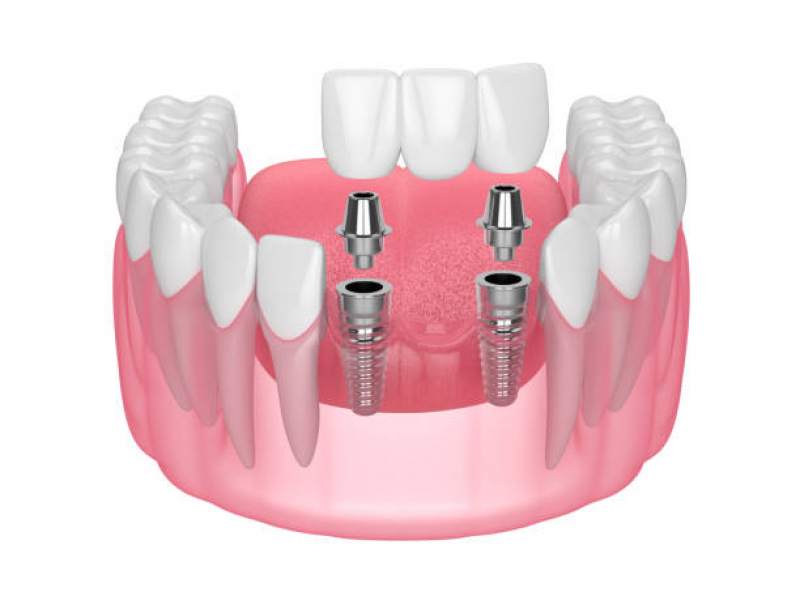 Clinica de Implante Dentário Fixo Brooklin Novo - Implante Dentário de Porcelana