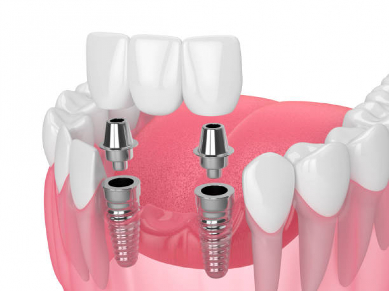 Clinica de Implante Dentario na Frente Jardim Ângela - Implante Dentário de Porcelana