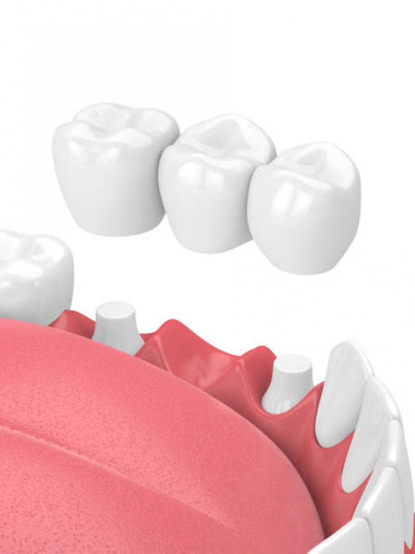 Clinica de Implante nos Dentes Vila São José - Implante Dentário de Porcelana