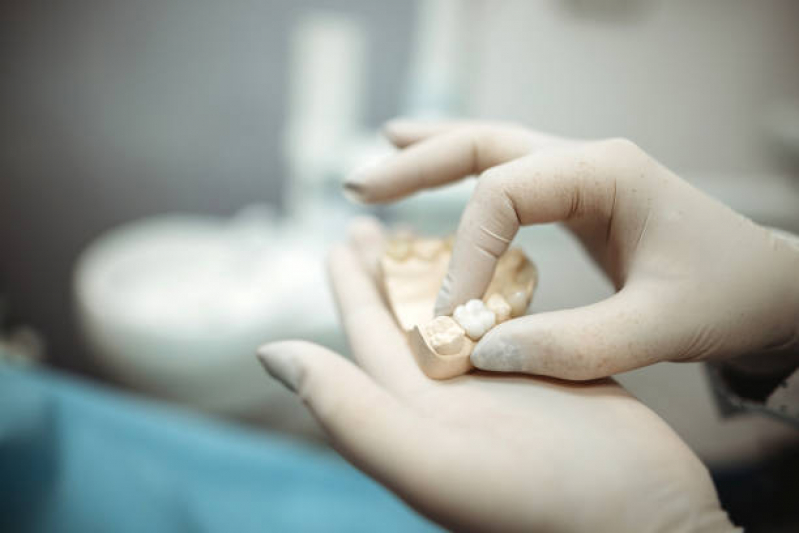 Clinica de Implantes de Dentes Bom Retiro - Implante no Dente da Frente