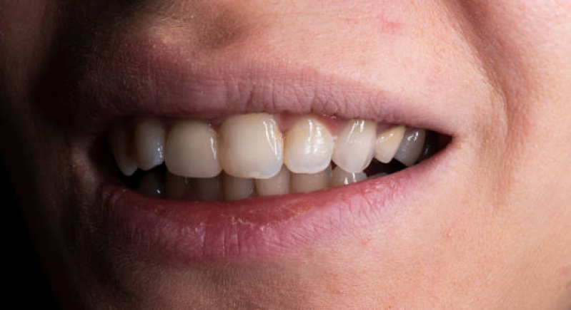 Clinica Especializada em Faceta de Porcelana nos Dentes Jardim Belga - Faceta de Porcelana no Dente