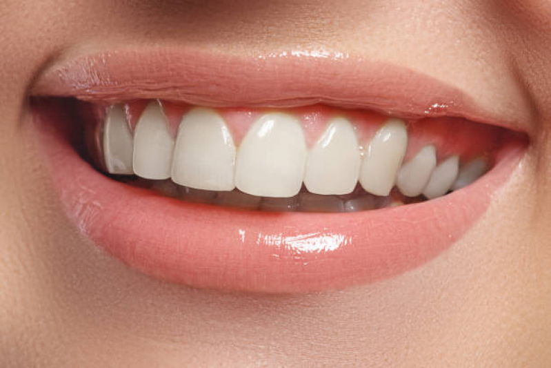 Clinica Especializada em Faceta nos Dentes da Frente Próximo/ Perto GAZETA - Faceta de Porcelana em Apenas um Dente