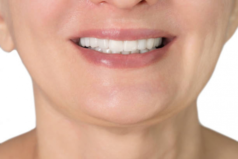 Clinica Especializada em Facetas de Porcelana para Os Dentes Próximo/ Perto ANHEMBI - Facetas de Porcelana para Os Dentes