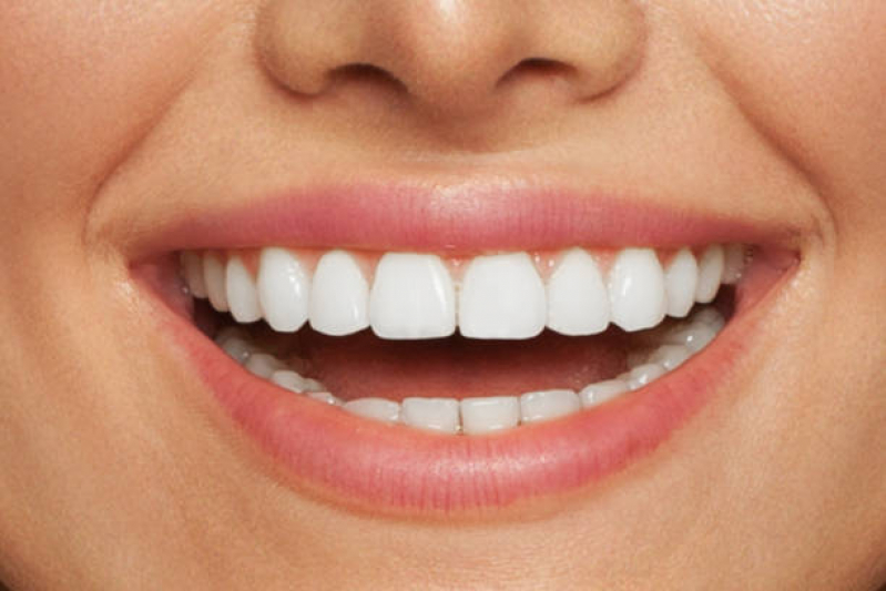 Clinica Especializada em Lente de Contato Dental Porcelana Clinicas - Lente de Porcelana para Dentes