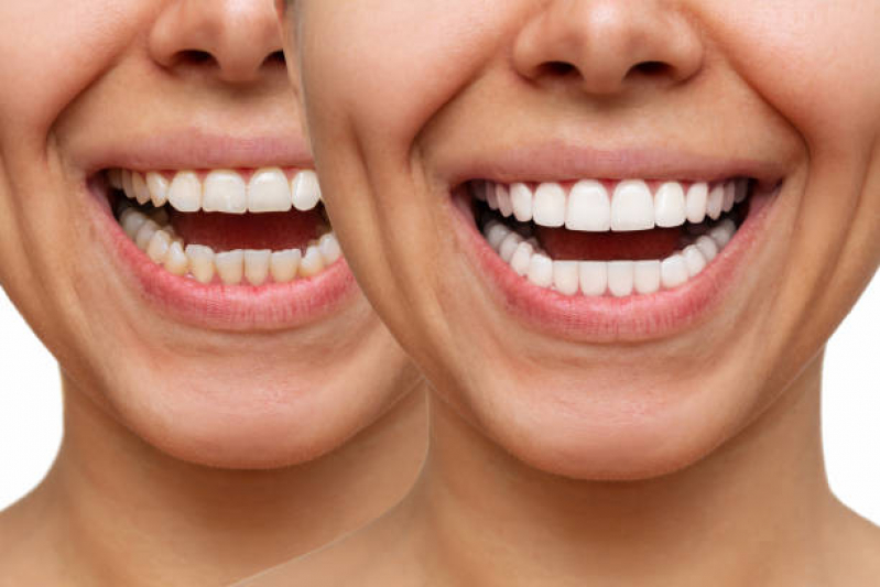 Clinica Que Faz Facetas de Porcelana Alameda Itu - Faceta para Os Dentes