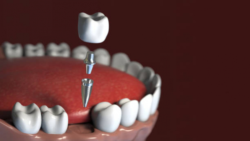 Clinica Que Faz Implante de Protese Dentaria Fixa Vila Olímpia - Implantes de Dentes