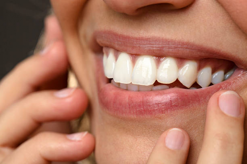 Clinica Que Faz Lente de Contato para o Dente Higienópolis - Lente Dental de Resina