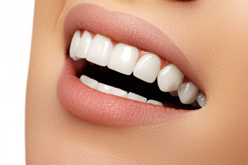 Clinica Que Faz Lente de Contato para Os Dentes Portal do Morumbi - Lente Odontológica