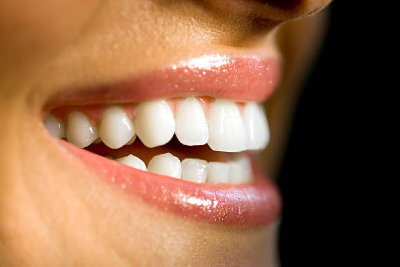 Clinica Que Faz Lente Odontológica Haddock Lobo - Lente de Contato para Os Dentes