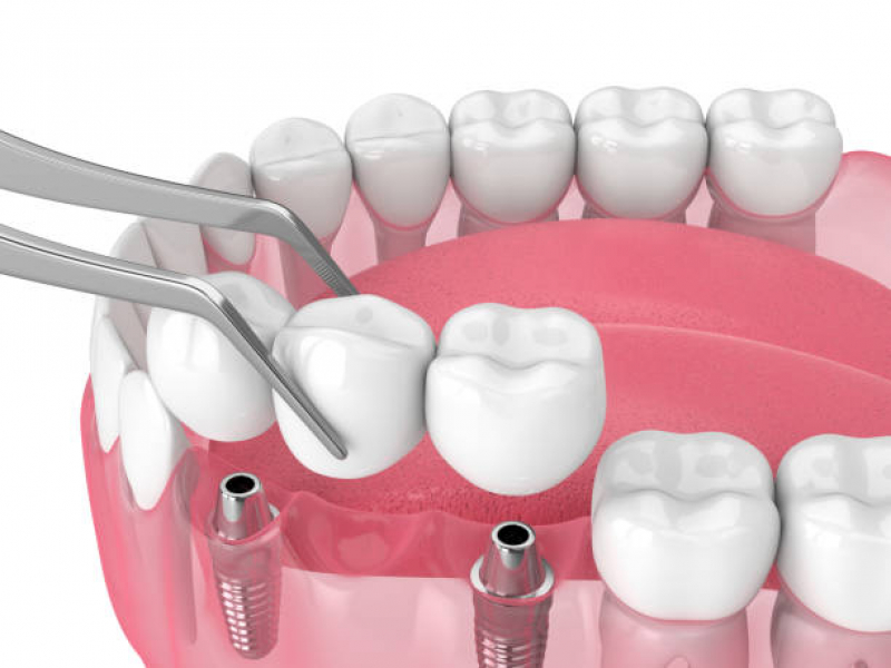 Dentista Que Faz Implante Dentario com Enxerto Metrô Paraíso - Implante Dentário de Porcelana