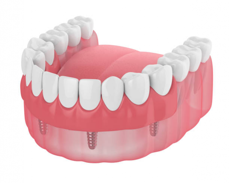 Dentista Que Faz Implante Dentário Completo Clinicas - Implante Dentário de Porcelana
