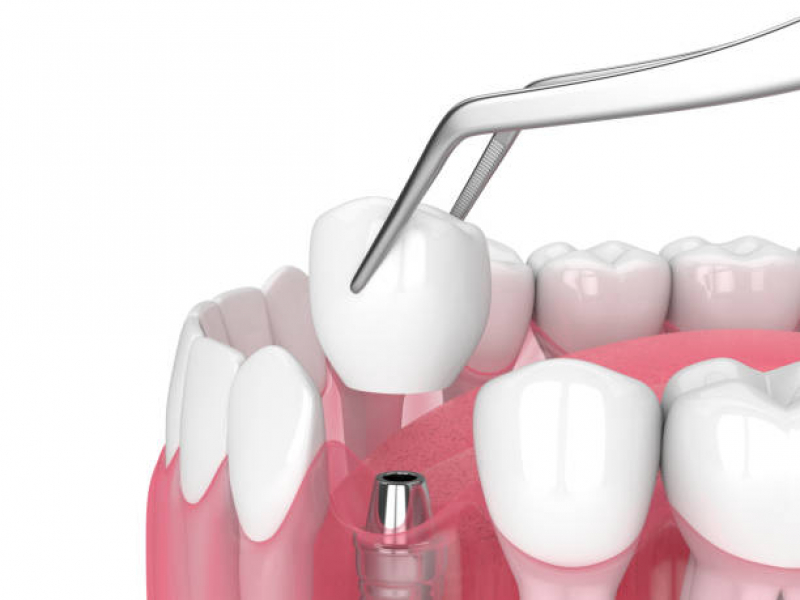 Dentista Que Faz Implante Dentário de um Dente Vila Água Funda - Implante Dentário Inferior