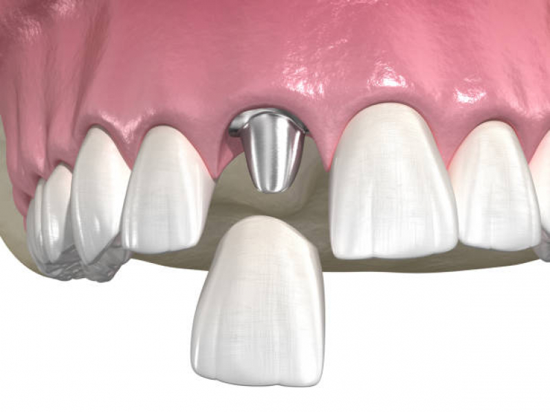 Dentista Que Faz Implante Dentário Fixo Rua Haddock Lobo - Implante Dentário Superior