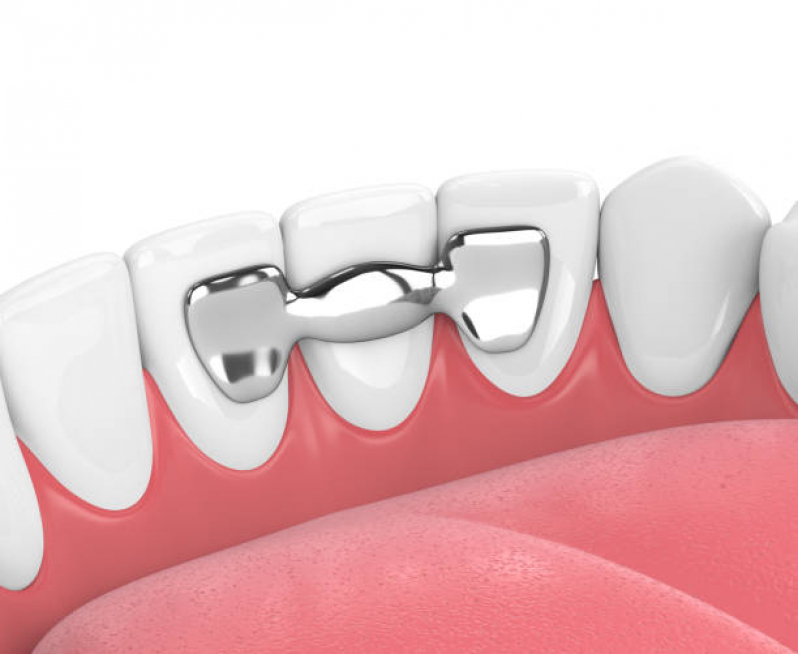Dentista Que Faz Implante nos Dentes Vila Mascote - Implante Dentario na Frente