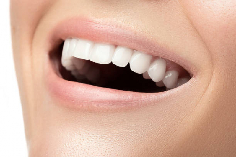 Dentista Que Faz Lente de Porcelana para Dentes Paraíso - Lente de Contato dos Dentes