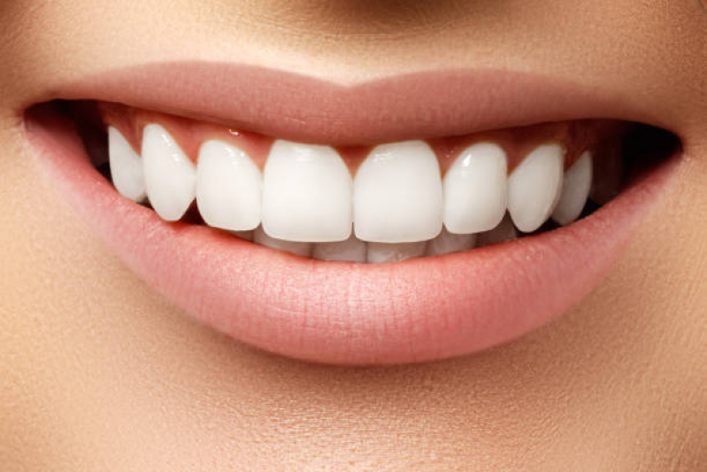 Dentista Que Faz Lente Dentária Consolação - Lente para Os Dentes