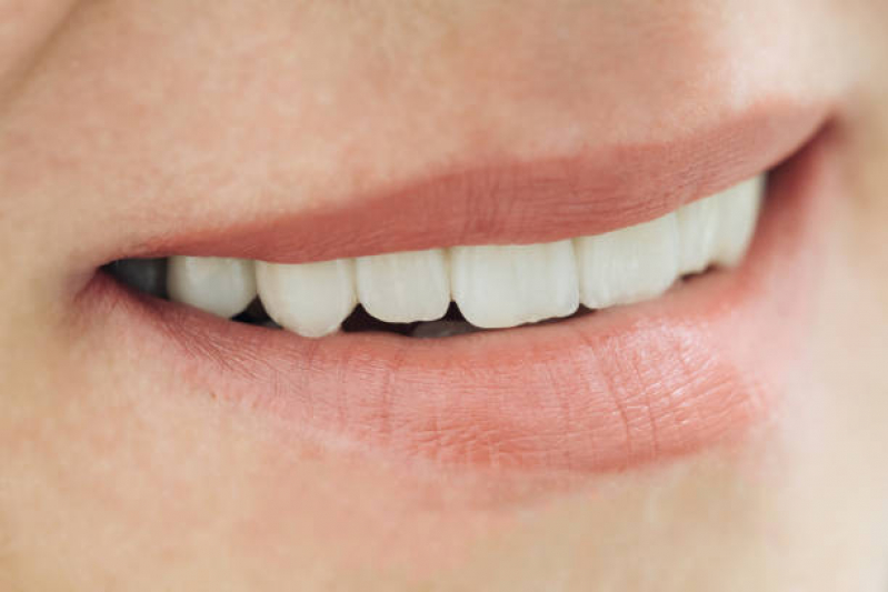 Faceta de Porcelana nos Dentes Marcar Morro dos Ingleses - Faceta para Os Dentes