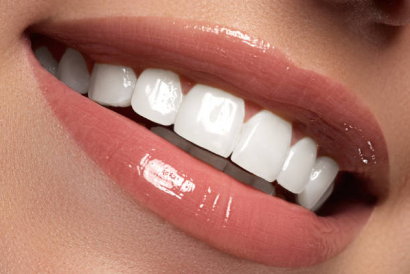 Faceta nos Dentes da Frente Marcar Aclimação - Faceta de Porcelana nos Dentes