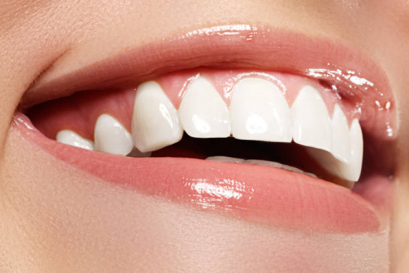 Faceta nos Dentes da Frente Socorro - Faceta de Porcelana em Apenas um Dente