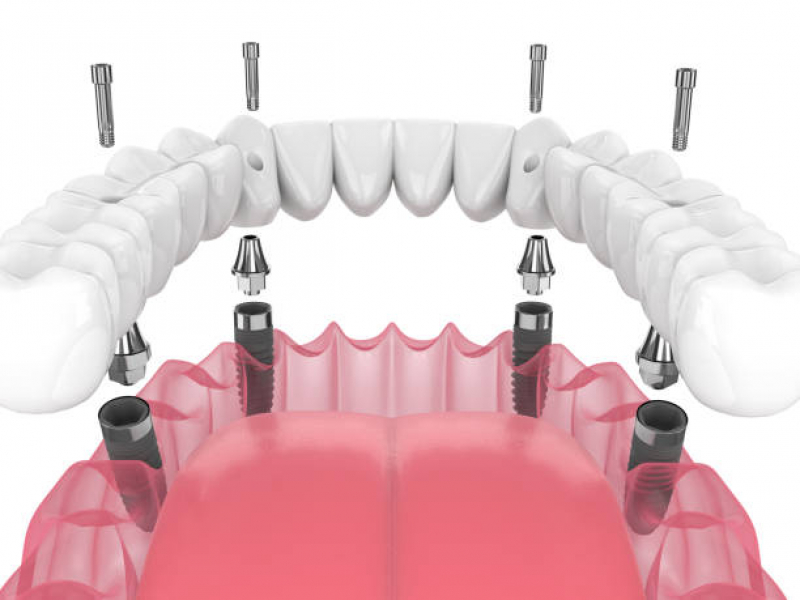 Implante de Protese Dentaria Fixa Marcar Moema Índios - Implante de Resina Dental