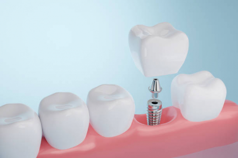 Implante de Protese Dentaria Fixa Bixiga - Implante de Todos Os Dentes