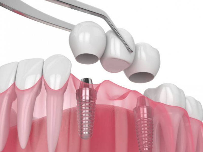 Implante Dentario com Enxerto Marcar Morumbi - Implante Dentário de Porcelana