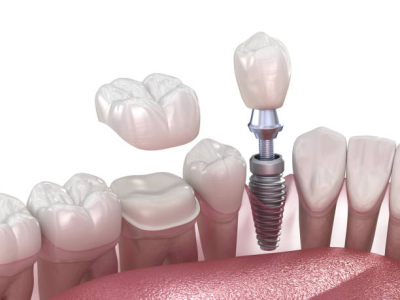 Implante Dentario com Enxerto Vila Clementino - Implante Dentário de Porcelana