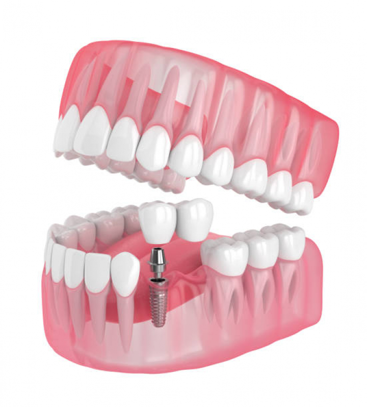 Implante Dentário Completo Agendar Hipódromo - Implante Dentário de Porcelana