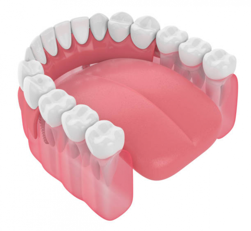 Implante Dentário Completo Marcar Socorro - Implante Dentário de Porcelana