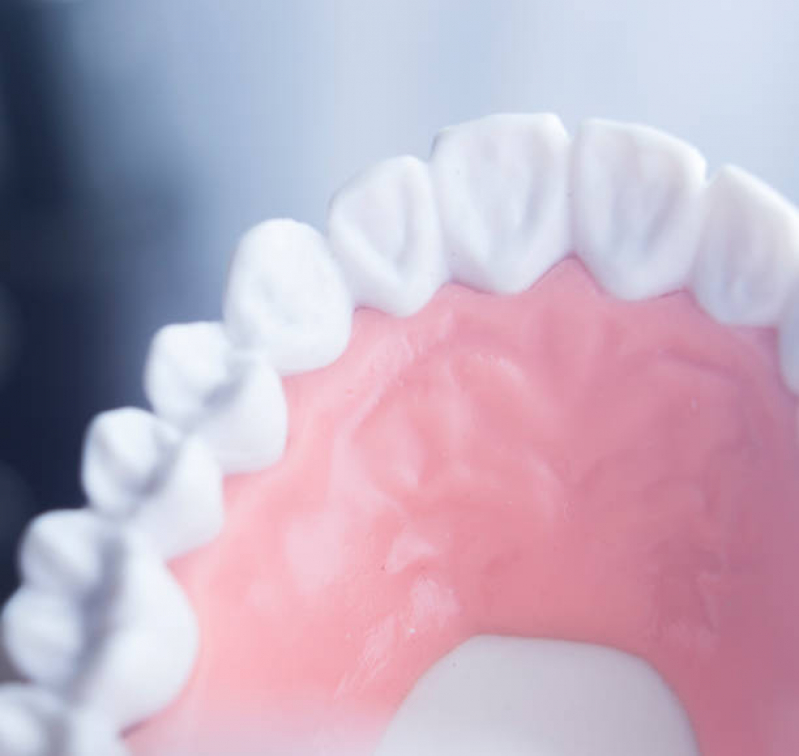 Implante Dentário Completo Vila Independência - Implante Dentário de Porcelana