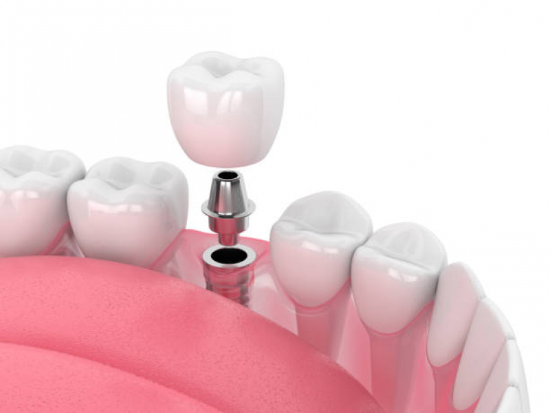 Implante Dentário de Porcelana Agendar Sé - Implante Dentário de Porcelana