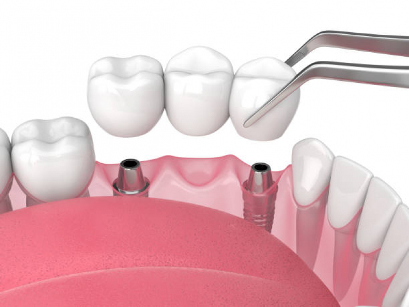 Implante Dentário de Porcelana Marcar Vila Clementino - Implante Dentário de Porcelana