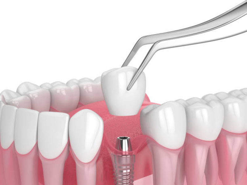 Implante Dentário de um Dente Marcar Jardim Marajoara - Implante Dentário Inferior
