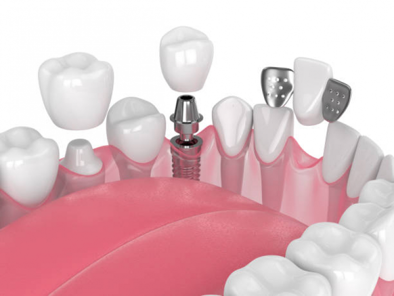 Implante Dentário de um Dente Vila Santa Mooca - Implante Dentário de Porcelana