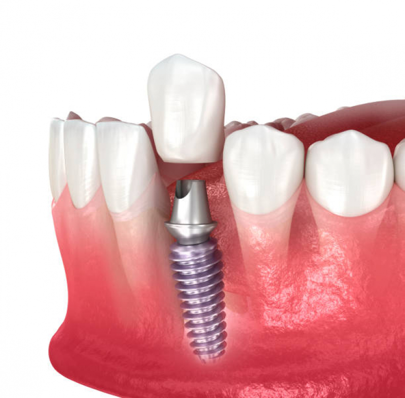 Implante Dentario Dente da Frente Marcar Brooklin Novo - Implante Dentário de Porcelana