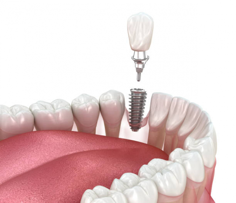 Implante Dentário Fixo Marcar Socorro - Implante Dentário Inferior