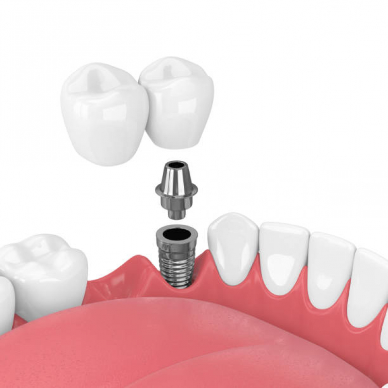 Implante Dentário Fixo Itaim Bibi - Implante Dentário de Porcelana