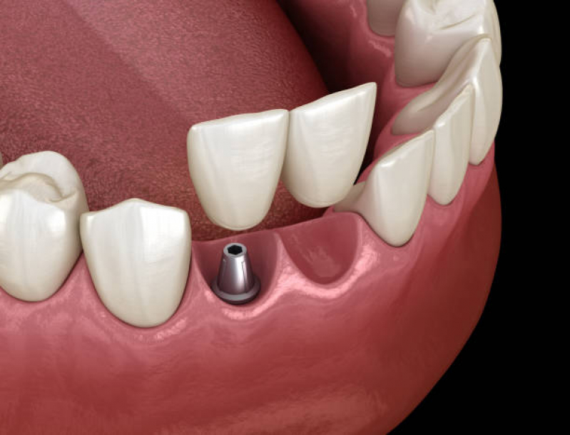 Implante Dentario na Frente Santo Amaro - Implante Dentário Superior