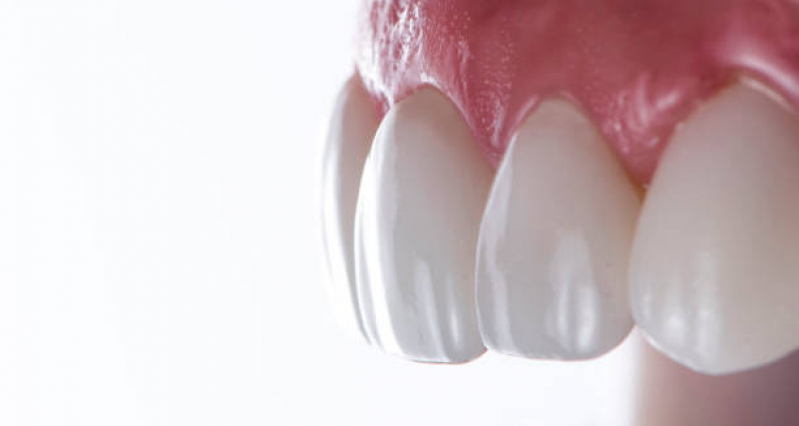 Implante Dentário Superior Marcar Jardim Caravelas - Implante Dentário de Porcelana