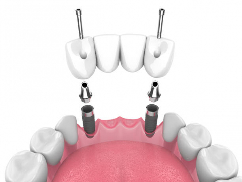 Implante Dentário Jardim Internacional - Implante Dentario Dente da Frente