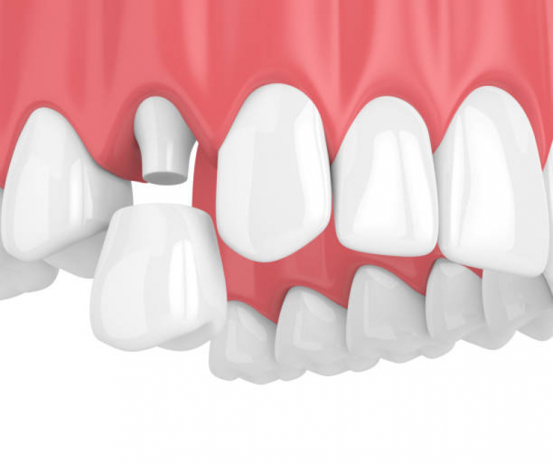 Implante nos Dentes Marcar Vila Helena - Implante Dentário de Porcelana