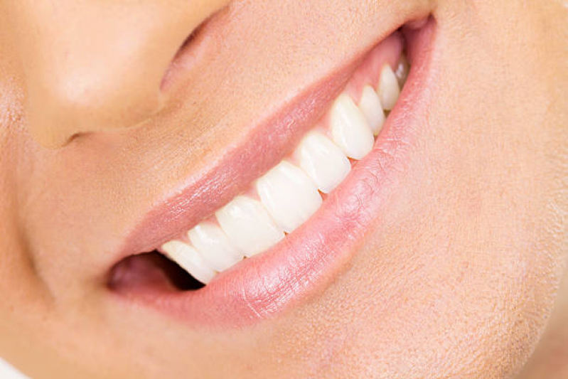Lente de Contato Dental Natural Higienópolis - Lente Dental de Resina
