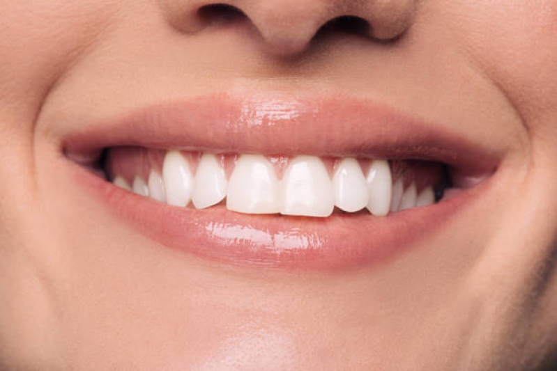 Lente de Contato Dentária Saúde - Lente de Contato nos Dentes