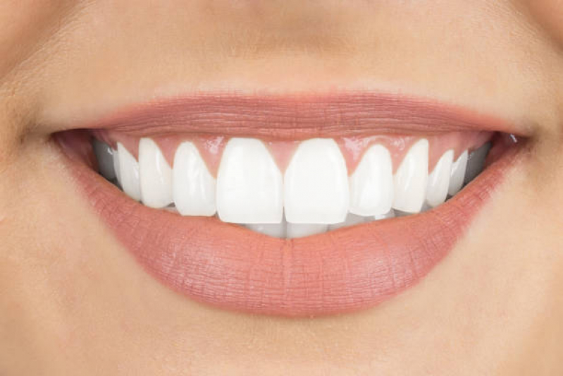 Lente de Contato em Dente Marcar Clinicas - Lente Dental de Resina