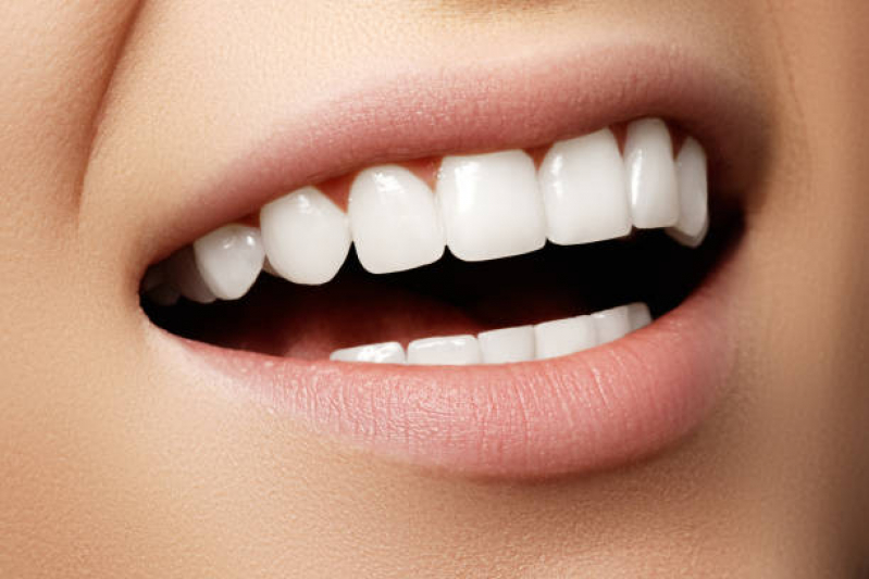 Lente de Contato para Os Dentes Agendar Augusta - Lente de Contato Faceta